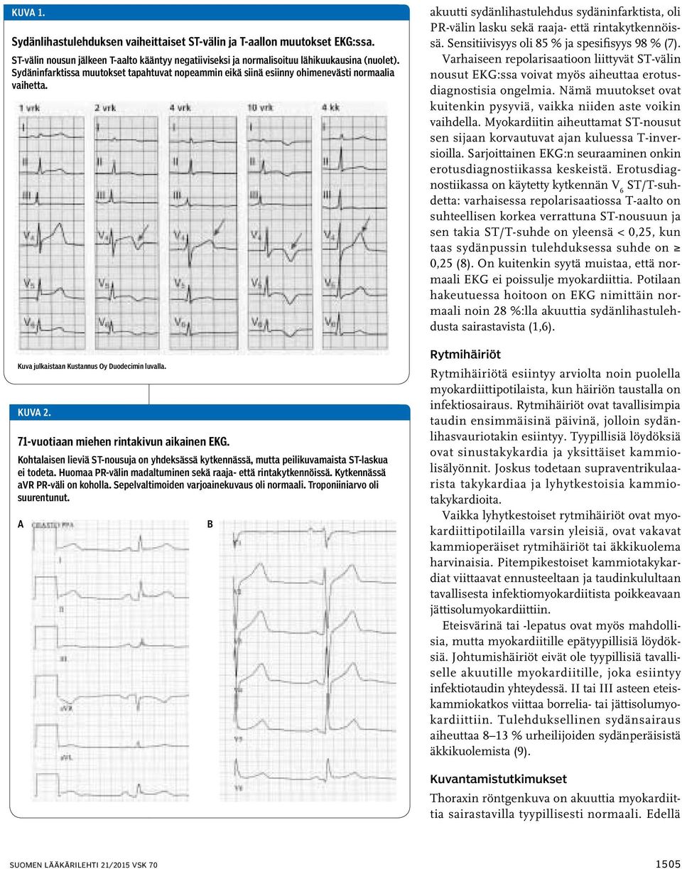 71-vuotiaan miehen rintakivun aikainen EKG. Kohtalaisen lieviä ST-nousuja on yhdeksässä kytkennässä, mutta peilikuvamaista ST-laskua ei todeta.