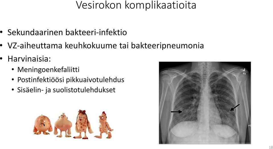 bakteeripneumonia Harvinaisia: Meningoenkefaliitti