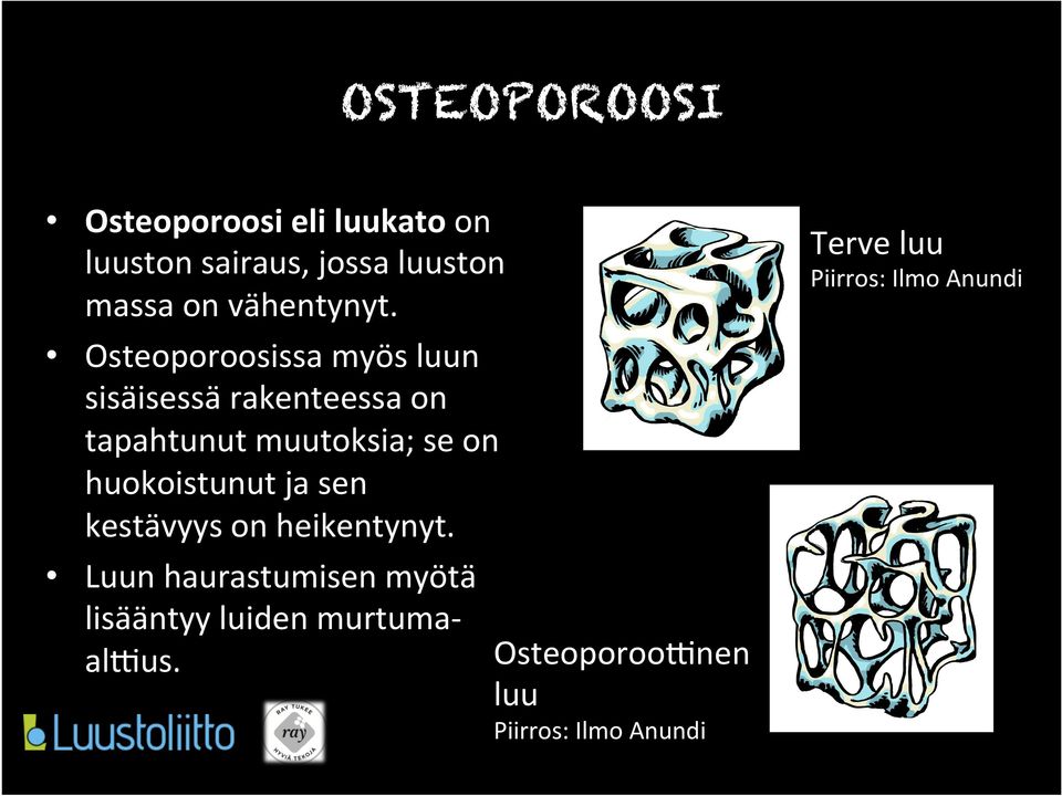 Osteoporoosissa myös luun sisäisessä rakenteessa on tapahtunut muutoksia; se on