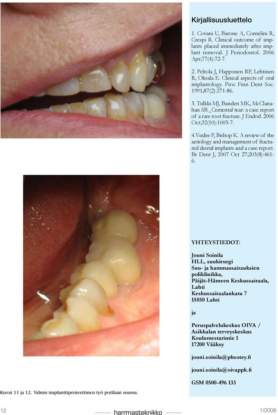 _Cemental tear: a case report of a rare root fracture. J Endod. 2006 Oct;32(10):1005-7. 4.Virdee P, Bishop K. A review of the aetiology and management of fractured dental implants and a case report.