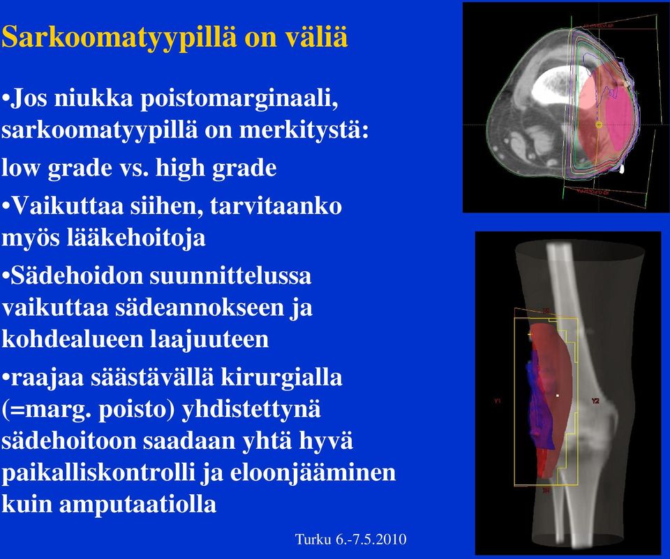 high grade Vaikuttaa siihen, tarvitaanko myös lääkehoitoja Sädehoidon suunnittelussa vaikuttaa