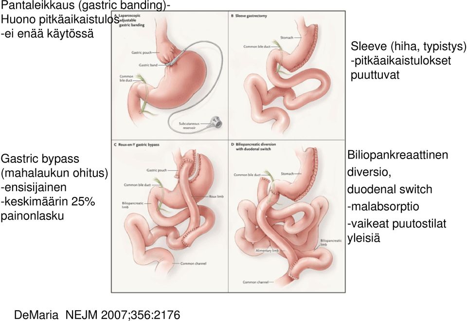 ohitus) -ensisijainen -keskimäärin 25% painonlasku Biliopankreaattinen diversio,