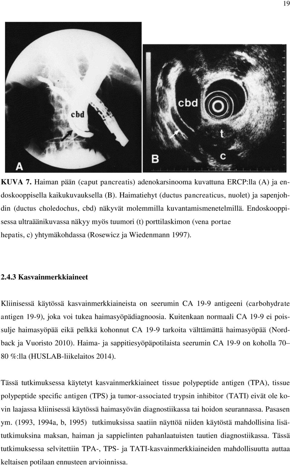 Endoskooppisessa ultraäänikuvassa näkyy myös tuumori (t) porttilaskimon (vena portae hepatis, c) yhtymäkohdassa (Rosewicz ja Wiedenmann 1997). 2.4.