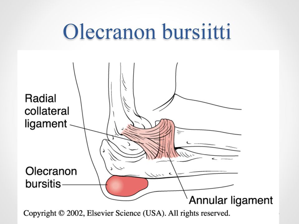 bursiitti