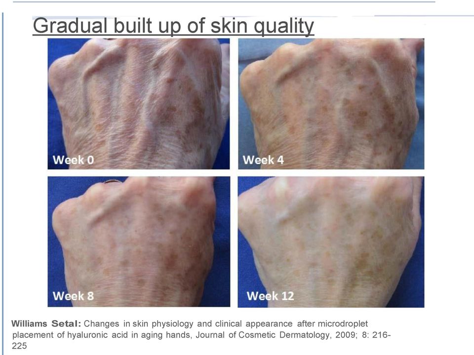 placement of hyaluronic acid in aging hands,