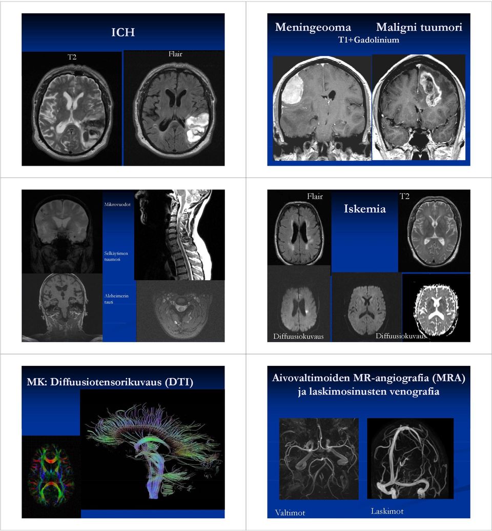 Diffuusiokuvaus Diffuusiokuvaus MK: Diffuusiotensorikuvaus (DTI)