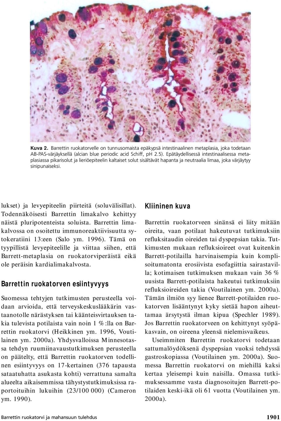 lukset) ja levyepiteelin piirteitä (soluvälisillat). Todennäköisesti Barrettin limakalvo kehittyy näistä pluripotenteista soluista.