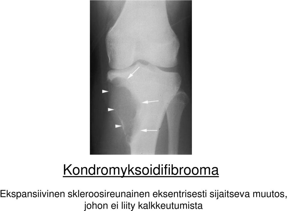 skleroosireunainen