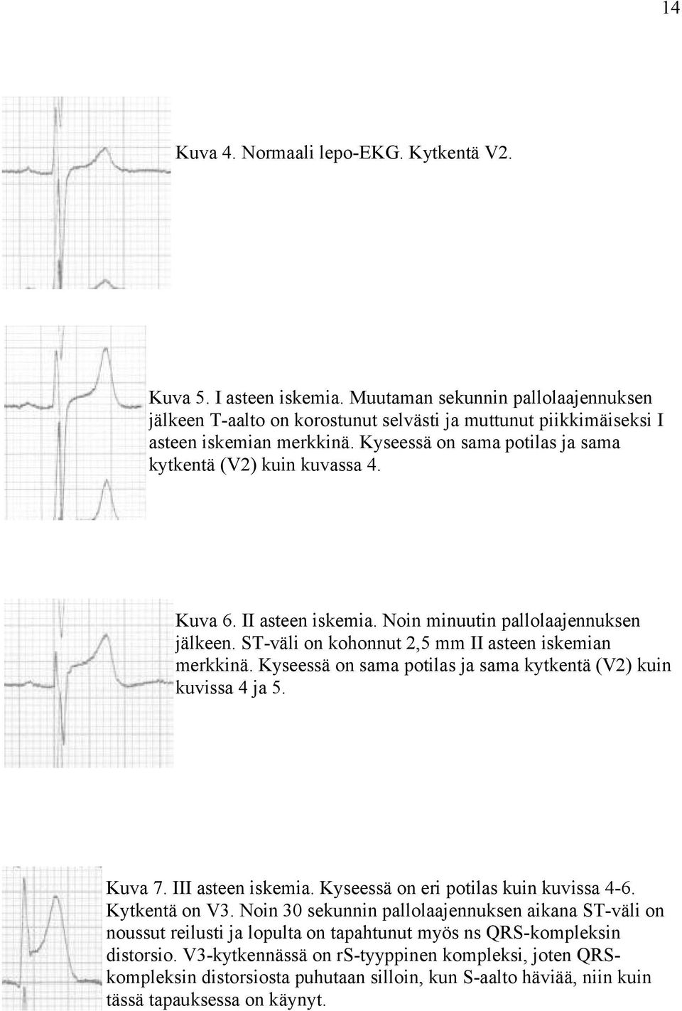 Kyseessä on sama potilas ja sama kytkentä (V2) kuin kuvissa 4 ja 5. Kuva 7. III asteen iskemia. Kyseessä on eri potilas kuin kuvissa 4-6. Kytkentä on V3.