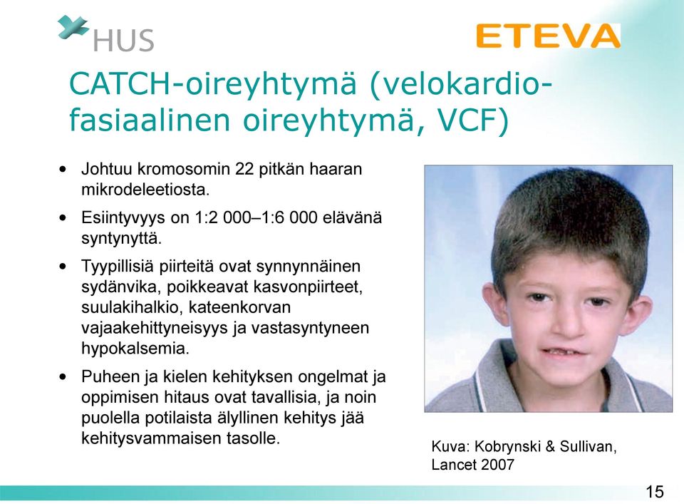 Tyypillisiä piirteitä ovat synnynnäinen sydänvika, poikkeavat kasvonpiirteet, suulakihalkio, kateenkorvan vajaakehittyneisyys