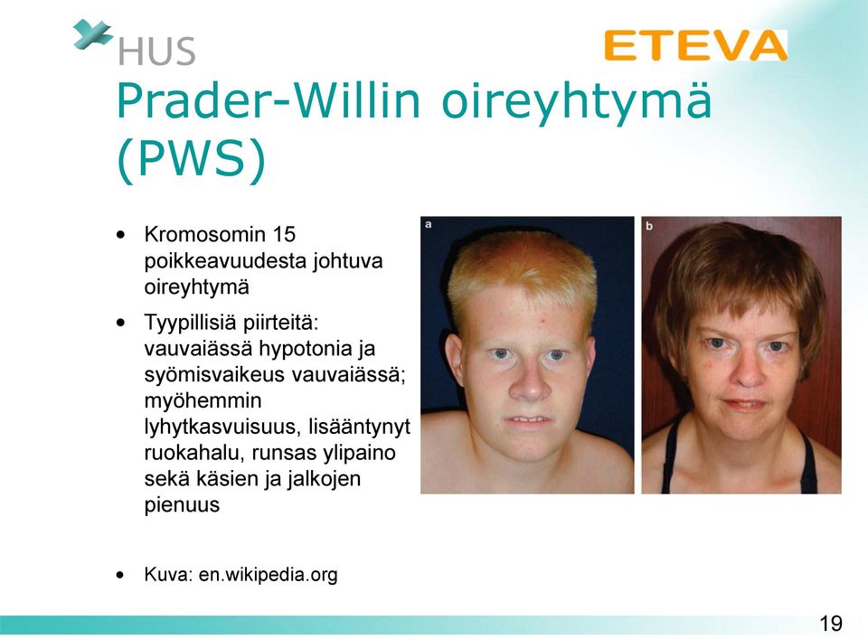 syömisvaikeus vauvaiässä; myöhemmin lyhytkasvuisuus, lisääntynyt