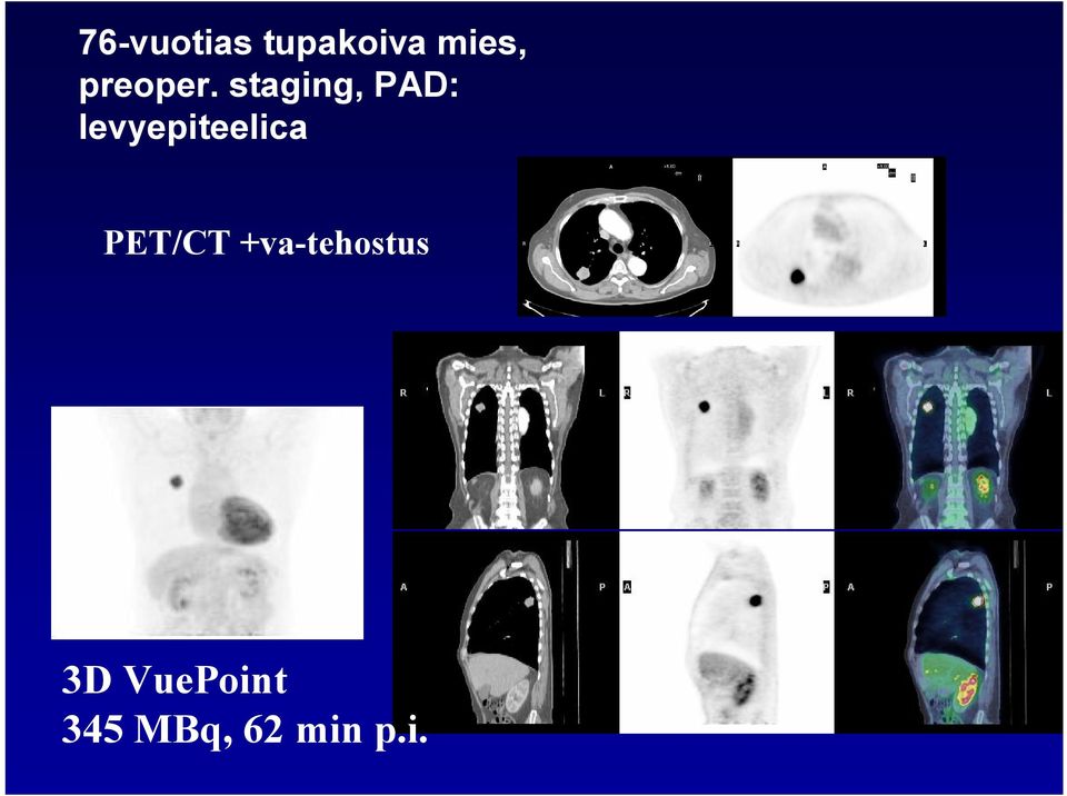 staging, PAD: levyepiteelica