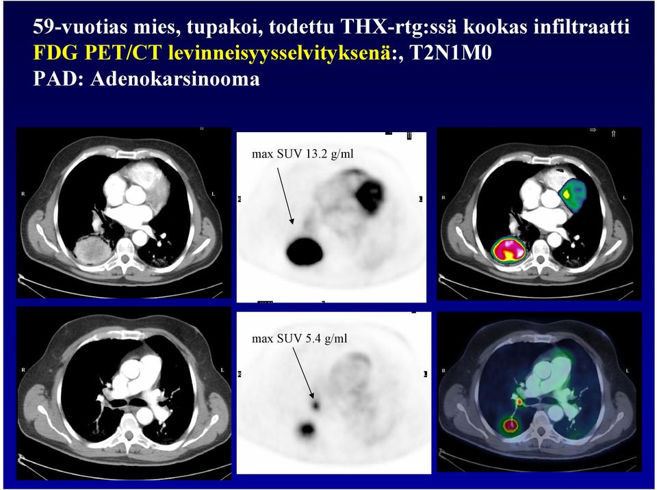 PET/CT levinneisyysselvityksenä:, T2N1M0