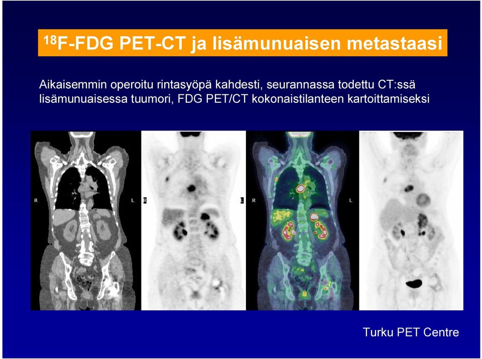 seurannassa todettu CT:ssä lisämunuaisessa