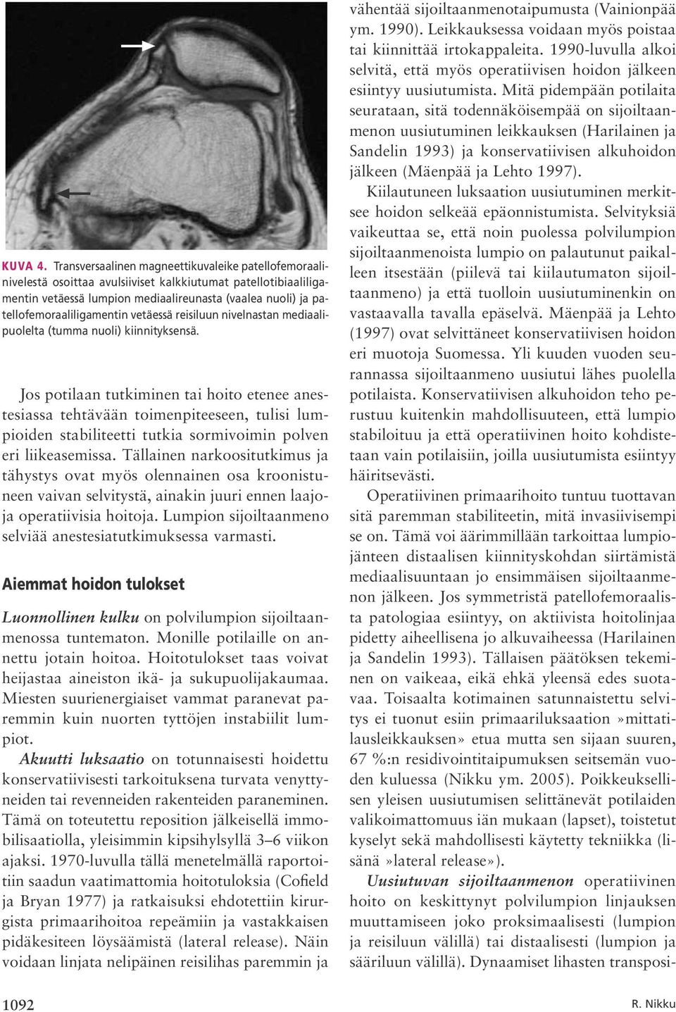 patellofemoraaliligamentin vetäessä reisiluun nivelnastan mediaalipuolelta (tumma nuoli) kiinnityksensä.