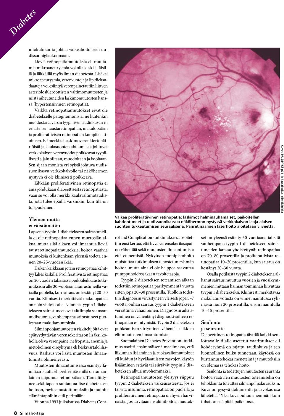 (hypertensiivinen retinopatia).