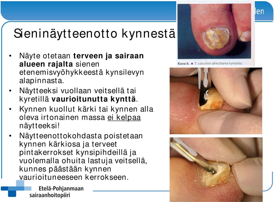 Kynnen kuollut kärki tai kynnen alla oleva irtonainen massa ei kelpaa näytteeksi!