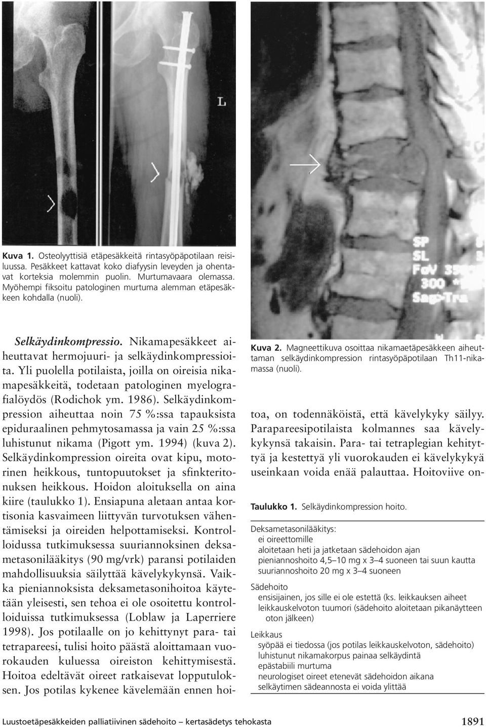 Magneettikuva osoittaa nikamaetäpesäkkeen aiheuttaman selkäydinkompression rintasyöpäpotilaan Th11-nikamassa (nuoli). Selkäydinkompressio.