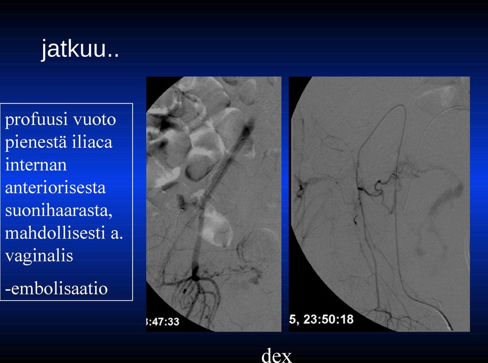 iliaca internan anteriorisesta