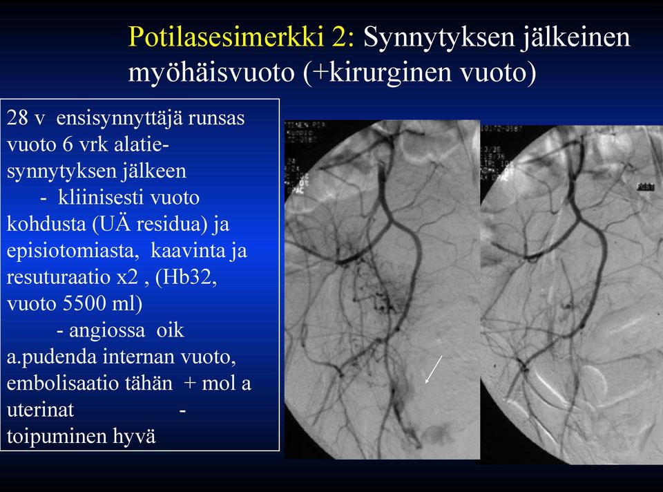 kohdusta (UÄ residua) ja episiotomiasta, kaavinta ja resuturaatio x2, (Hb32, vuoto