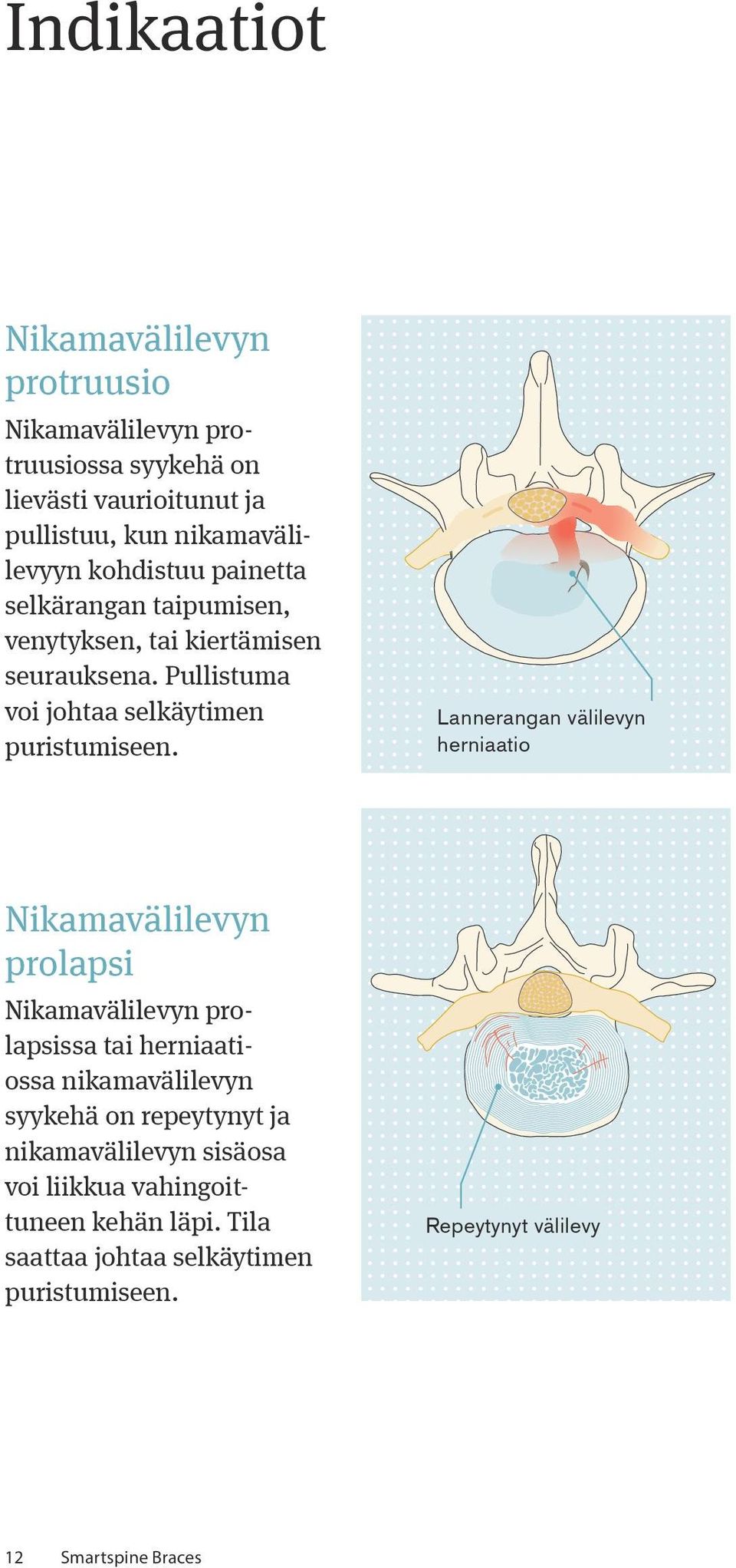 Lannerangan välilevyn herniaatio Nikamavälilevyn prolapsi Nikamavälilevyn prolapsissa tai herniaatiossa nikamavälilevyn syykehä on repeytynyt