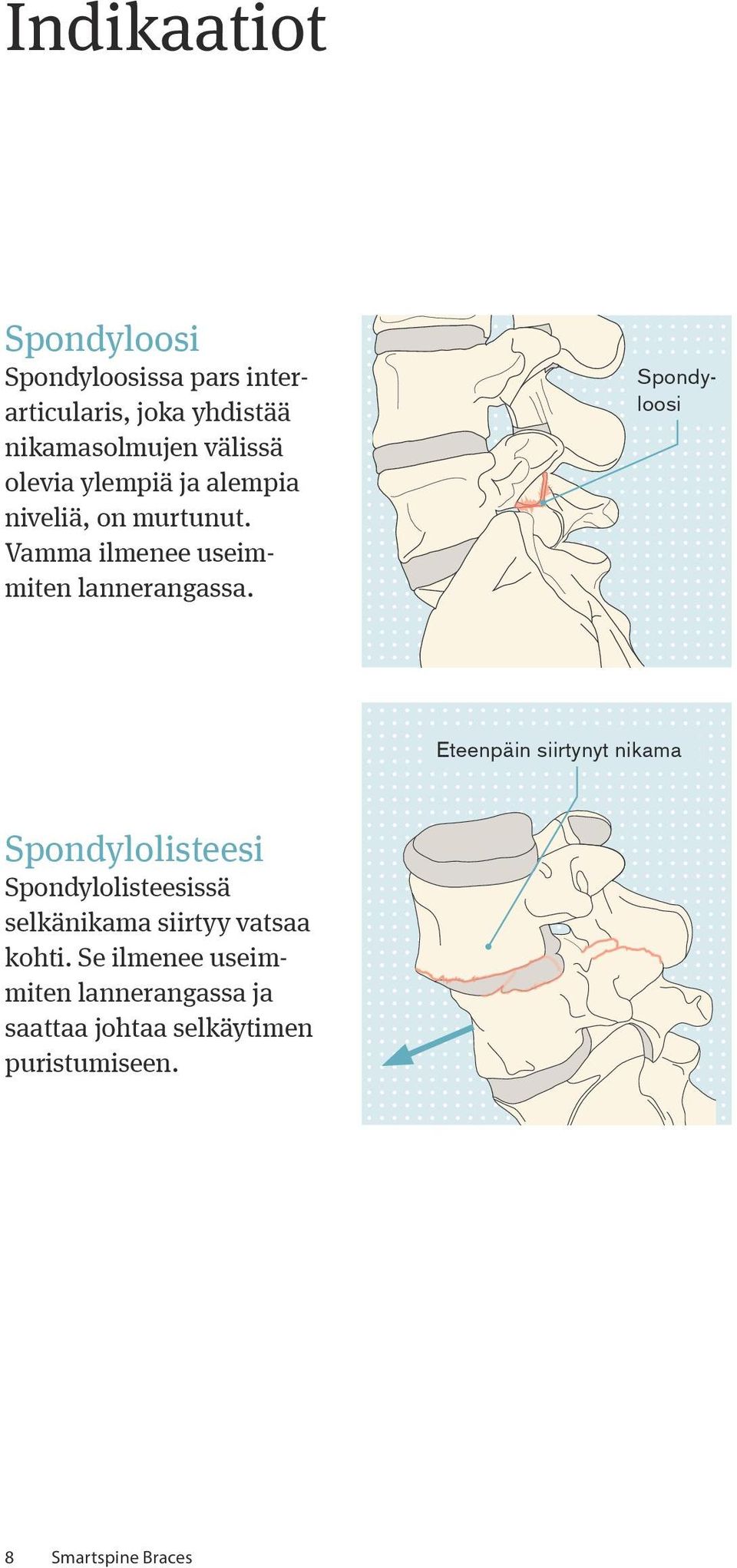 Spondyloosi Eteenpäin siirtynyt nikama Spondylolisteesi Spondylolisteesissä selkänikama siirtyy