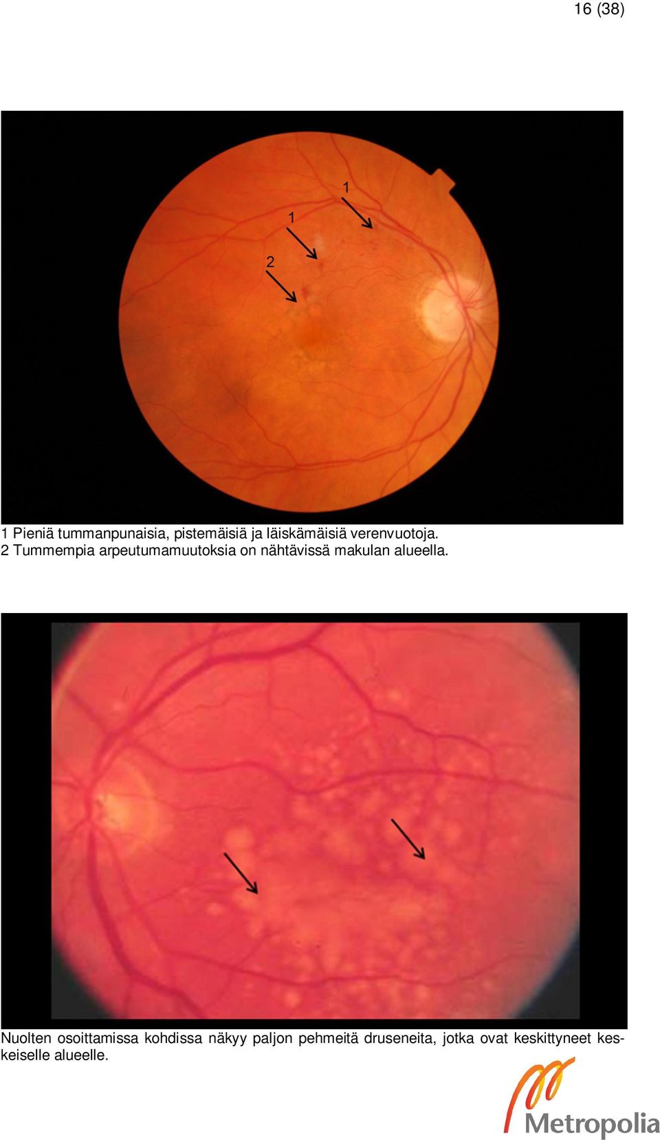 2 Tummempia arpeutumamuutoksia on nähtävissä makulan alueella.