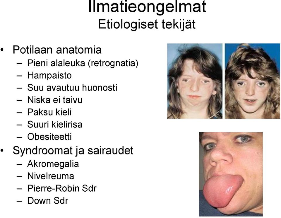 Obesiteetti Syndroomat ja sairaudet Akromegalia Nivelreuma