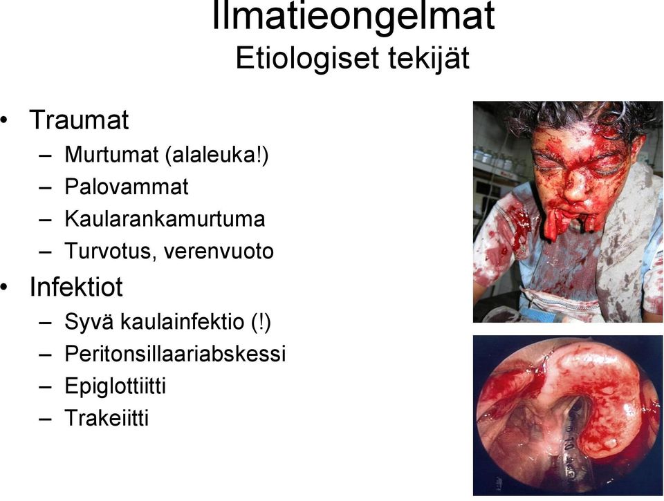 verenvuoto Infektiot Syvä kaulainfektio (!