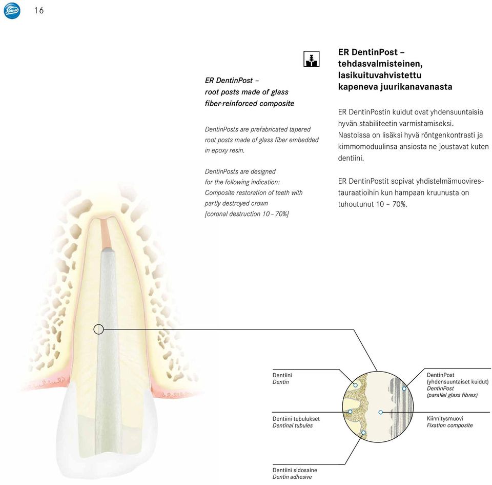 kapeneva juurikanavanasta ER DentinPostin kuidut ovat yhdensuuntaisia hyvän stabiliteetin varmistamiseksi.