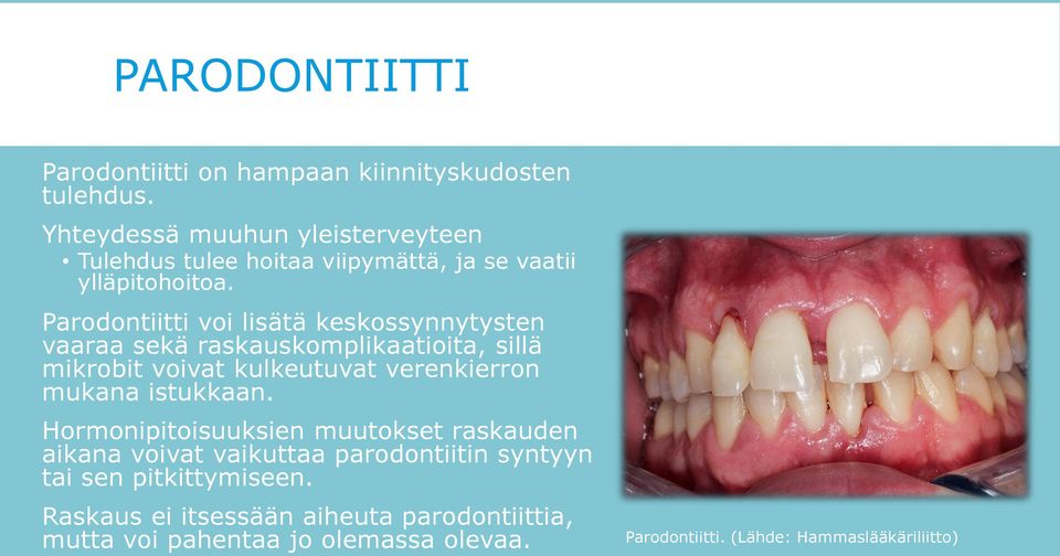 Parodontiitti voi lisätä keskossynnytysten vaaraa sekä raskauskomplikaatioita, sillä mikrobit voivat kulkeutuvat verenkierron mukana