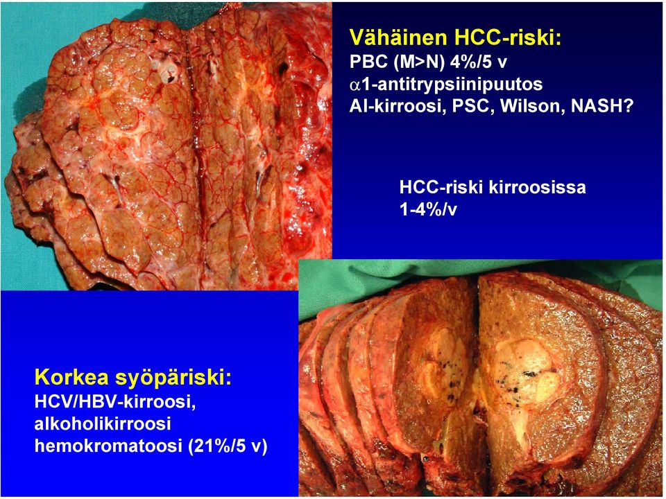 NASH? HCC-riski kirroosissa 1-4%/v Korkea