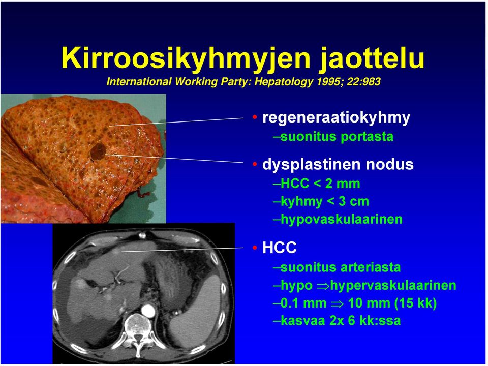 nodus HCC < 2 mm kyhmy < 3 cm hypovaskulaarinen HCC suonitus