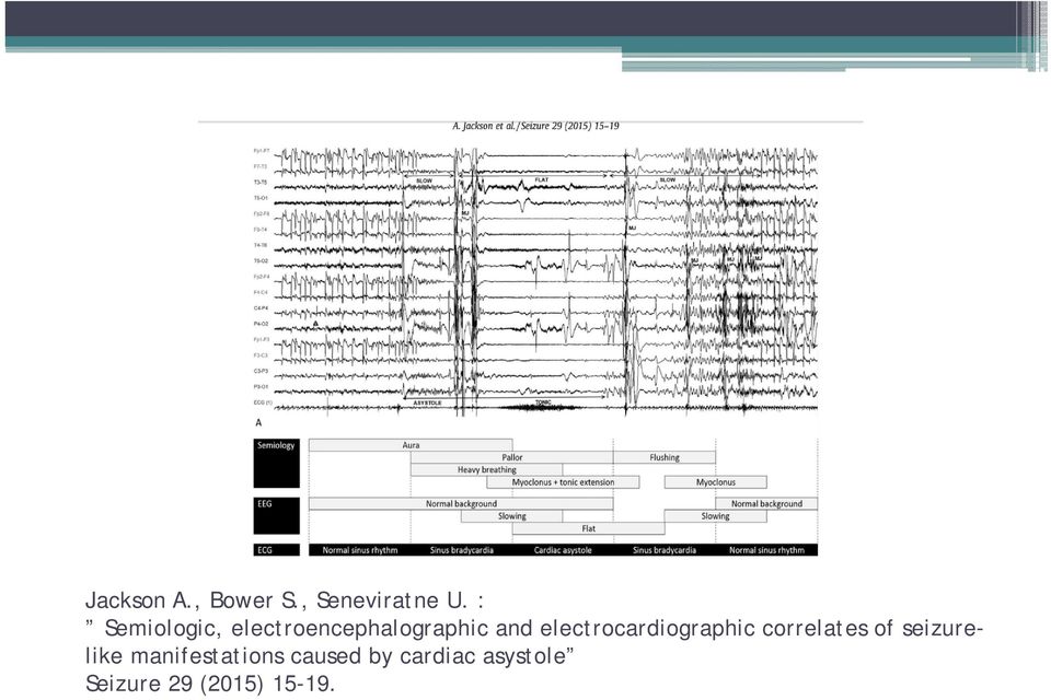 electrocardiographic correlates of seizurelike