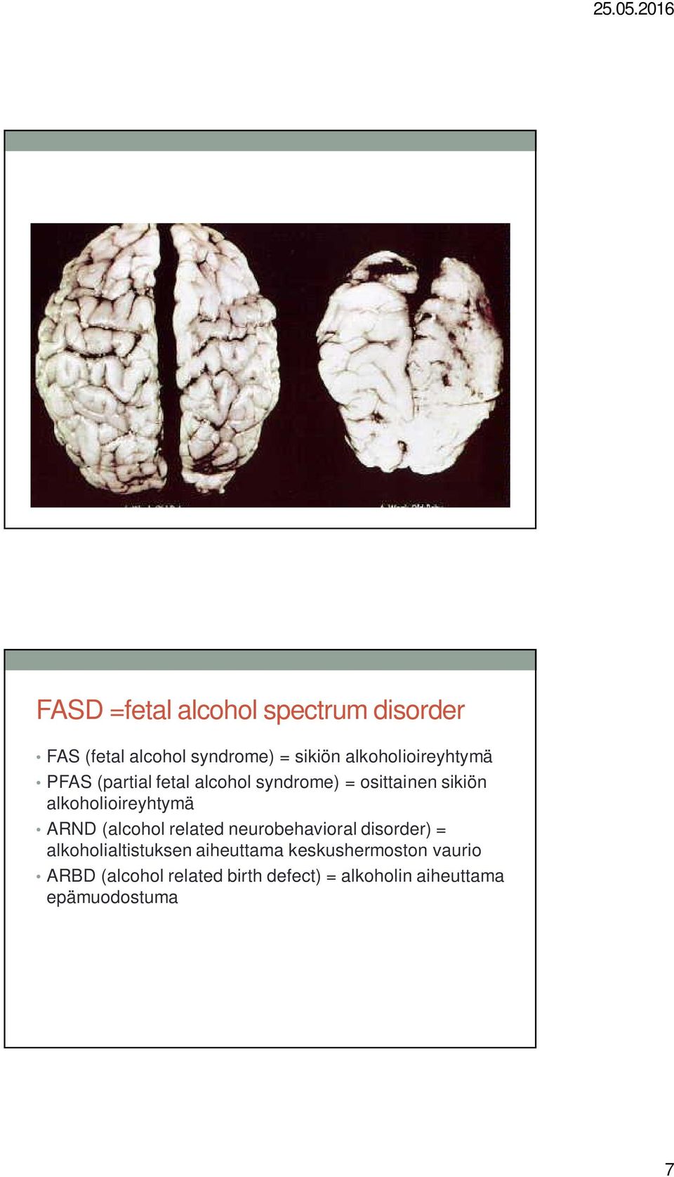 alkoholioireyhtymä ARND (alcohol related neurobehavioral disorder) =