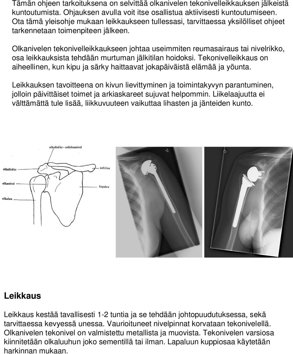 Olkanivelen tekonivelleikkaukseen johtaa useimmiten reumasairaus tai nivelrikko, osa leikkauksista tehdään murtuman jälkitilan hoidoksi.