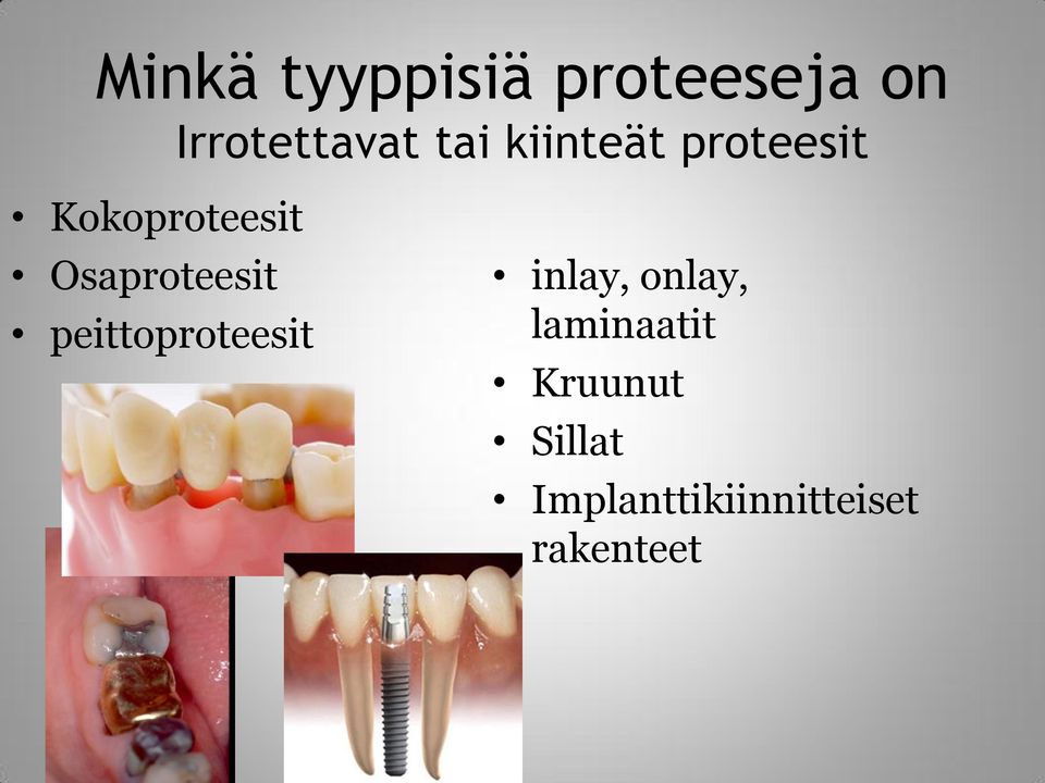 Osaproteesit peittoproteesit inlay, onlay,