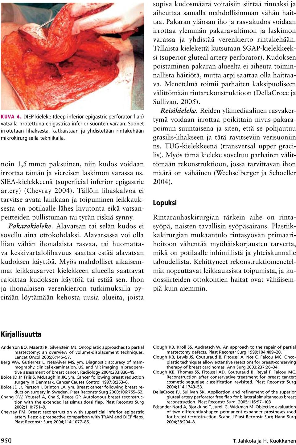 SIEA-kielekkeenä (superficial inferior epigastric artery) (Chevray 2004).