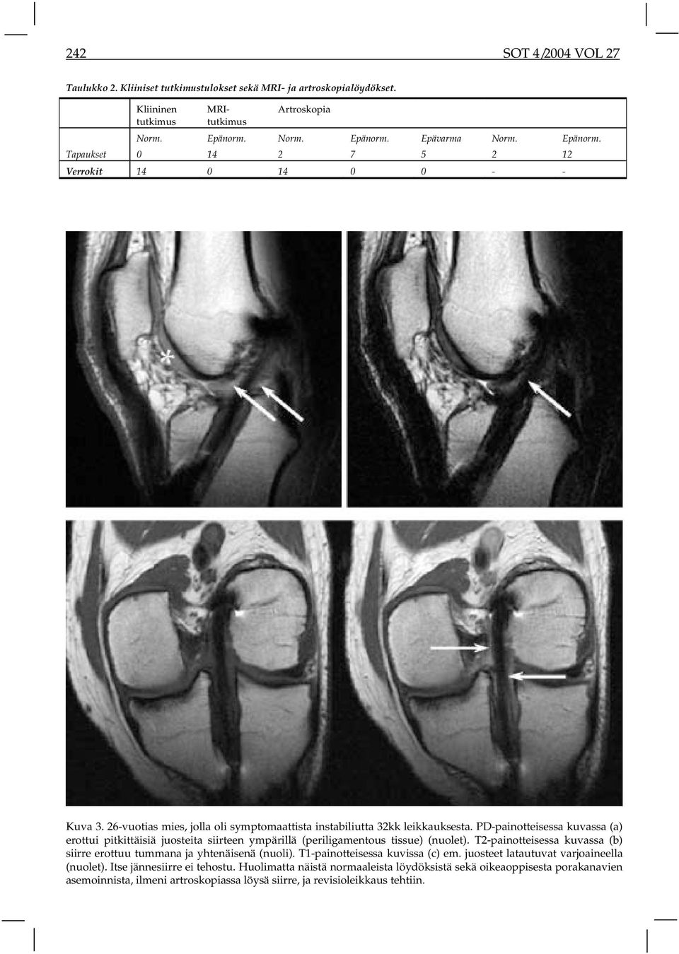 PD-painotteisessa kuvassa (a) erottui pitkittäisiä juosteita siirteen ympärillä (periligamentous tissue) (nuolet). T2-painotteisessa kuvassa (b) siirre erottuu tummana ja yhtenäisenä (nuoli).