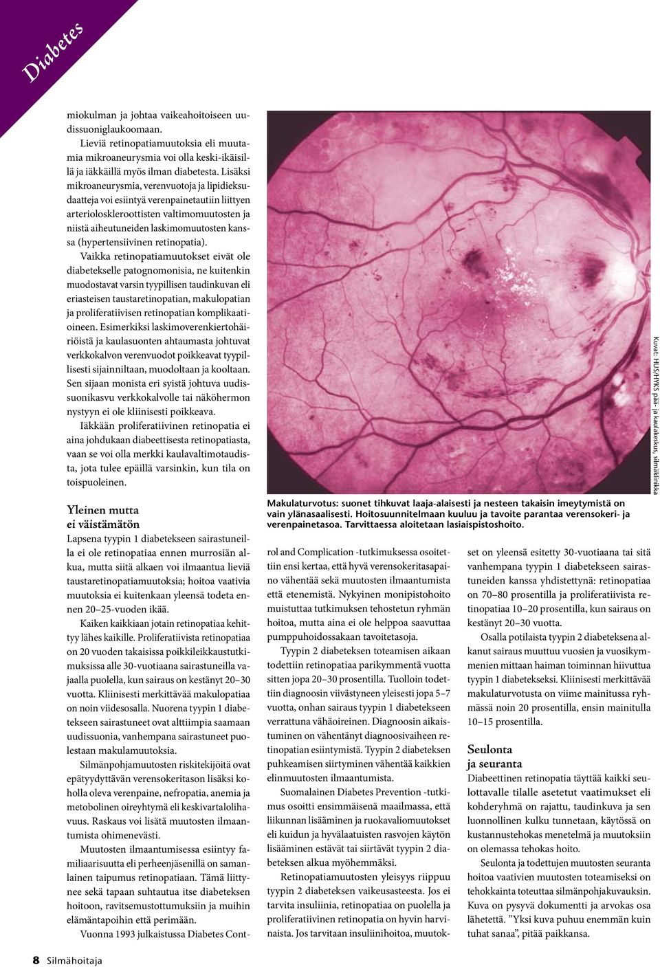 (hypertensiivinen retinopatia).