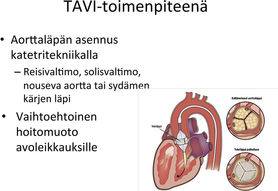 solisval0mo, nouseva aorna tai sydämen