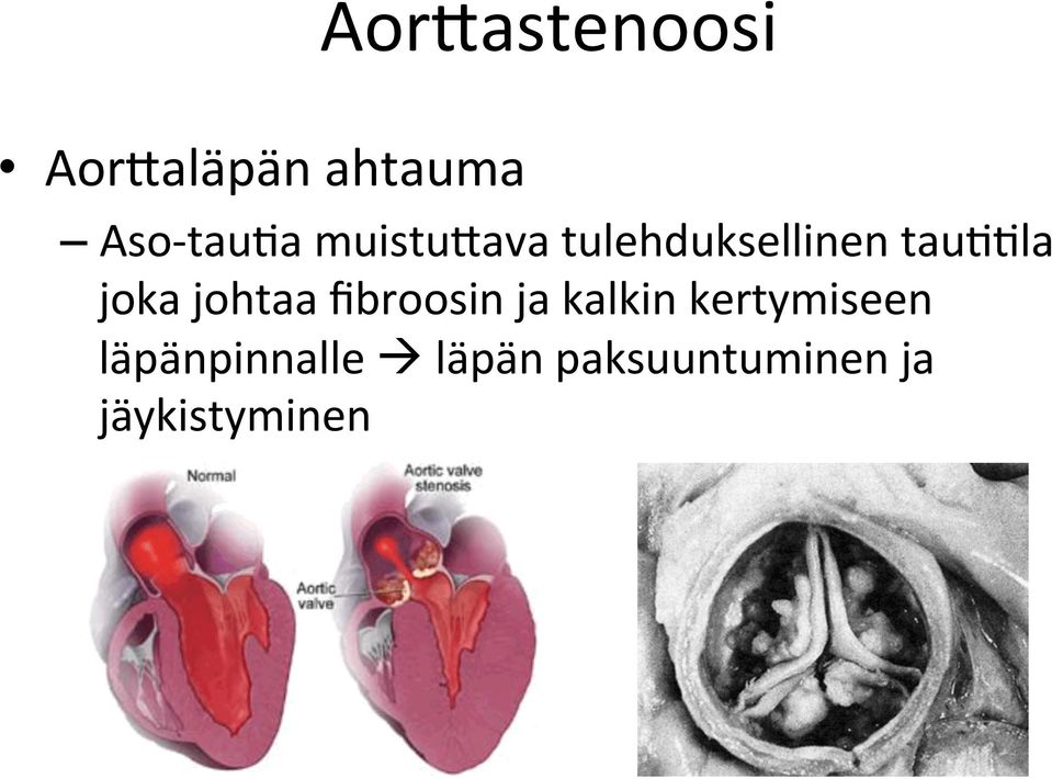 johtaa fibroosin ja kalkin kertymiseen