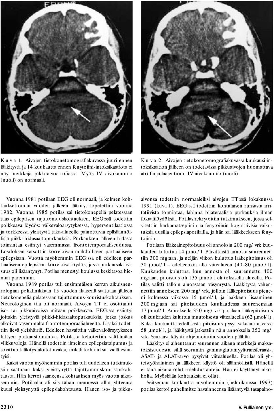 Vuonna 1981 potilaan EEG oli normaali, ja kolmen kohtauksettoman vuoden jälkeen lääkitys lopetettiin vuonna 1982.