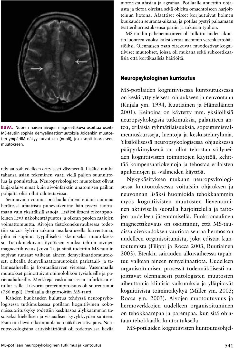 MS-taudin pahenemisoireet oli tulkittu niiden akuutin luonteen vuoksi kaksi kertaa aiemmin verenkiertohäiriöiksi.