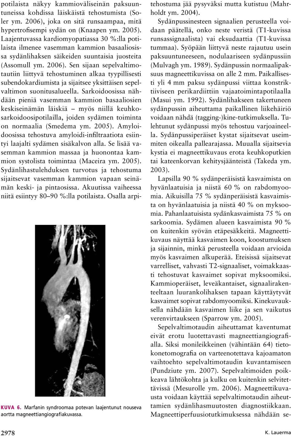 Laajentuvassa kardiomyopatiassa 30 %:lla potilaista ilmenee vasemman kammion basaaliosissa sydänlihaksen säikeiden suuntaisia juosteita (Assomull ym. 2006).