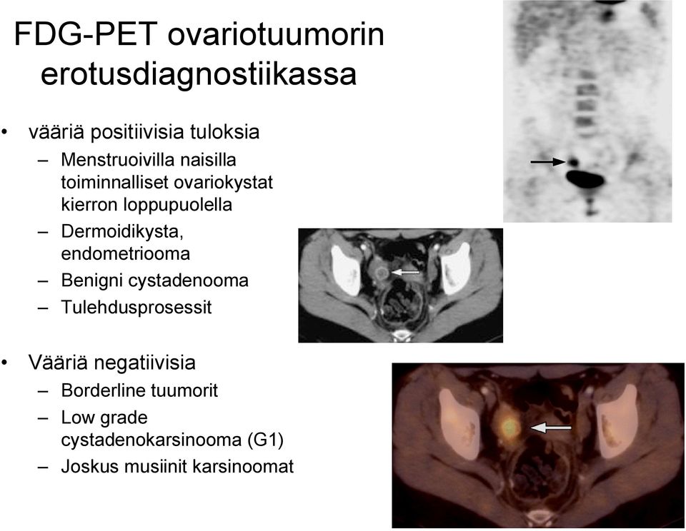 Dermoidikysta, endometriooma Benigni cystadenooma Tulehdusprosessit Vääriä