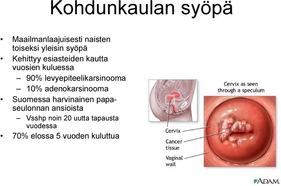 levyepiteelikarsinooma 10% adenokarsinooma Suomessa harvinainen