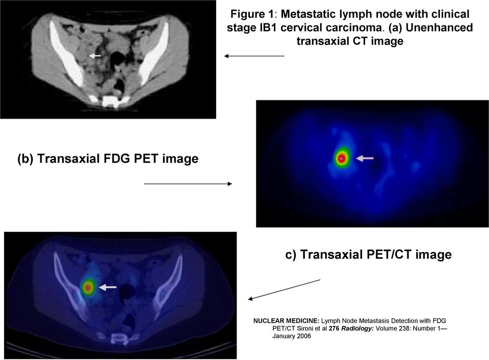 (a) Unenhanced transaxial CT image (b) Transaxial FDG PET image c)