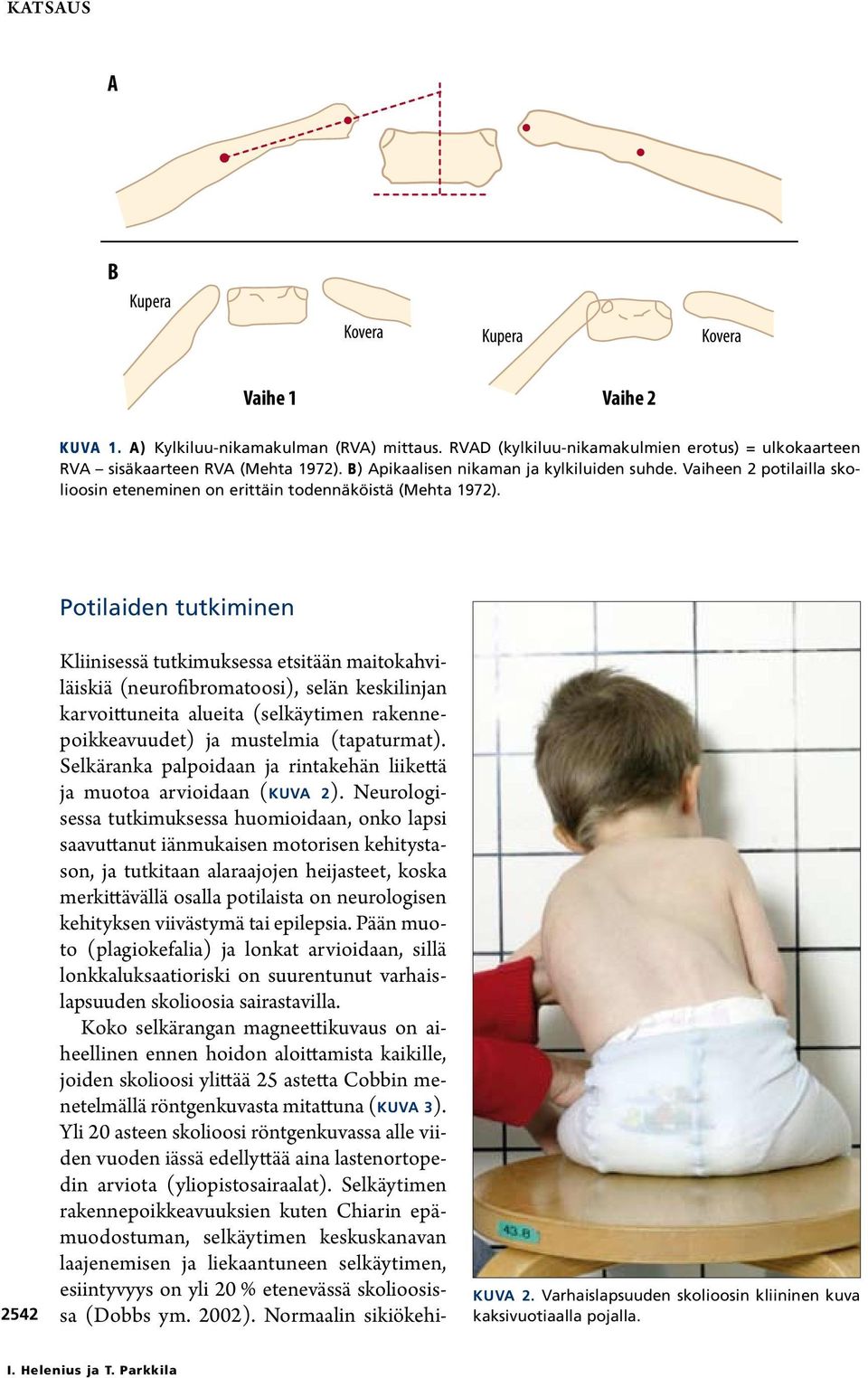 Potilaiden tutkiminen 2542 Kliinisessä tutkimuksessa etsitään maitokahviläiskiä (neurofibromatoosi), selän keskilinjan karvoittuneita alueita (selkäytimen rakennepoikkeavuudet) ja mustelmia