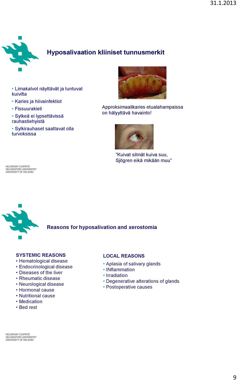 Kuivat silmät kuiva suu, Sjögren eikä mikään muu Reasons for hyposalivation and xerostomia SYSTEMIC REASONS Hematological disease Endocrinological disease Diseases